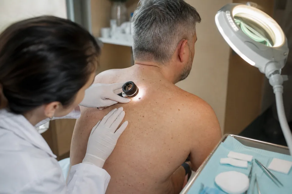 Dermatologist examining a mole on a patient's shoulder with a handheld dermatoscope